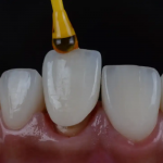 The Traveler’s Guide To Invisalign Cleaning On The Go