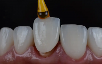 The Traveler’s Guide To Invisalign Cleaning On The Go