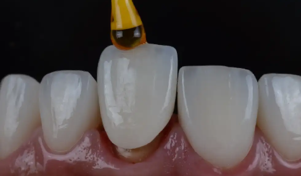 The Traveler’s Guide To Invisalign Cleaning On The Go