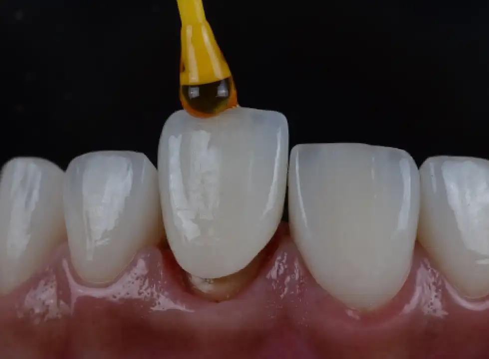 The Traveler’s Guide To Invisalign Cleaning On The Go