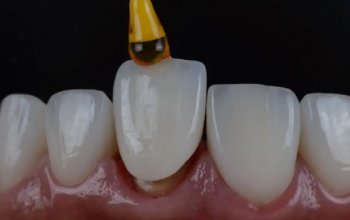 The Traveler’s Guide To Invisalign Cleaning On The Go
